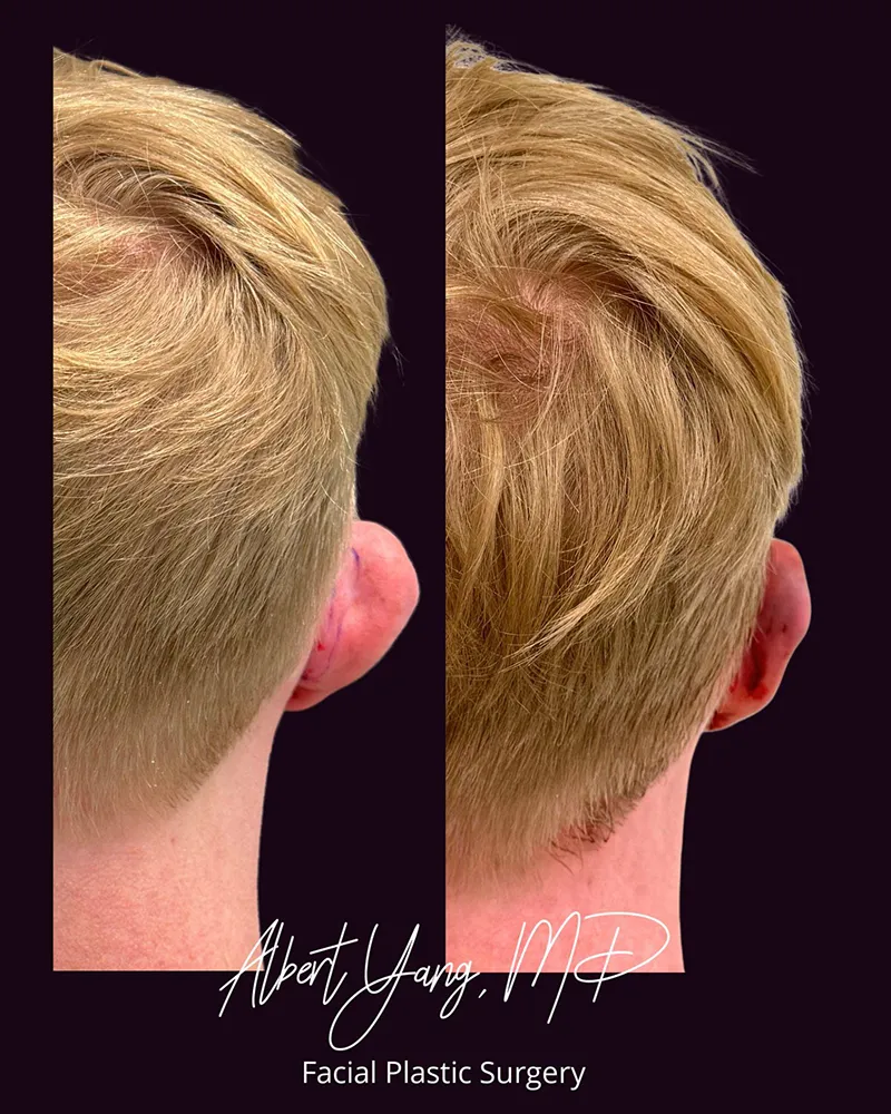 back view before and after otoplasty photos
