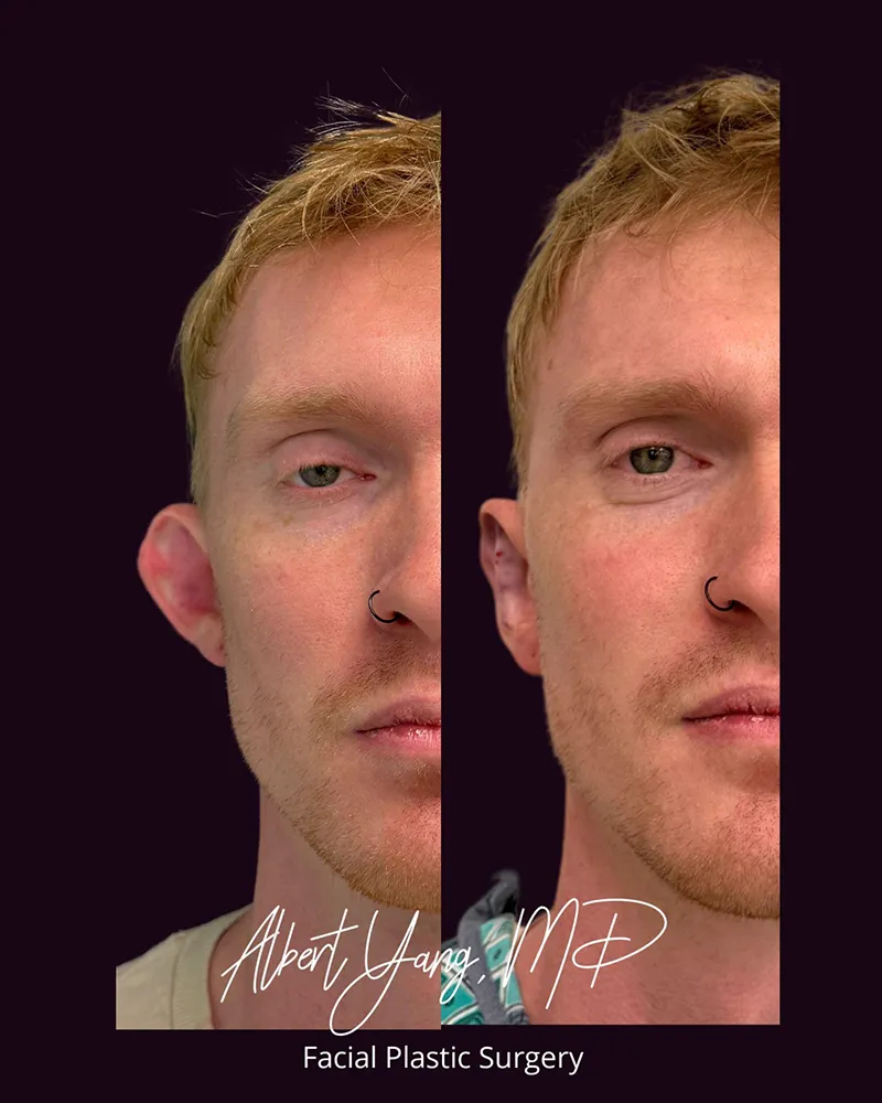 front view before and after otoplasty photos