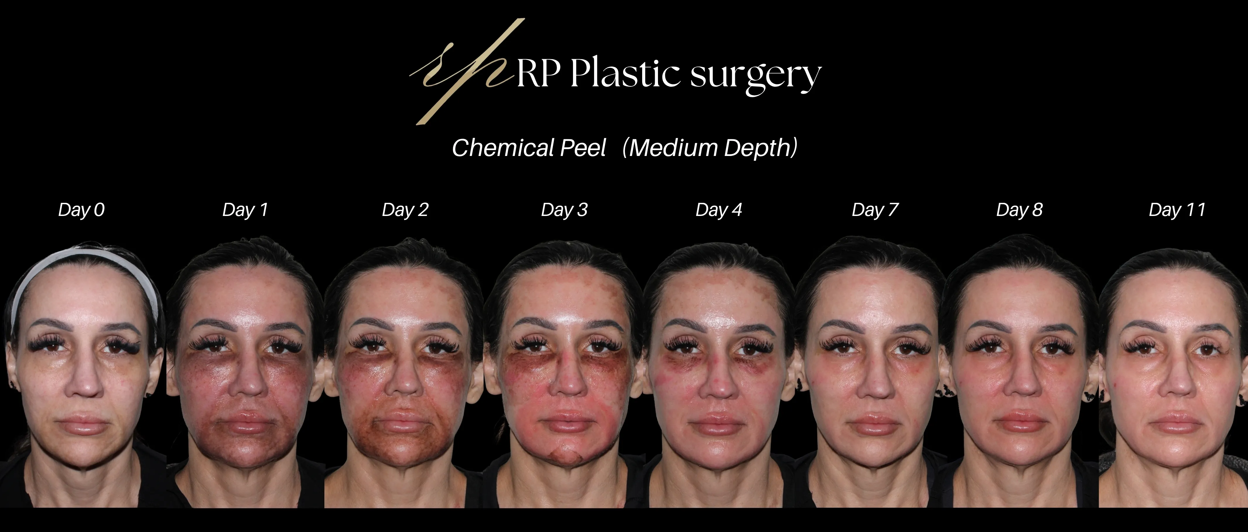 Day 0-11 Chemical Peel result front view
