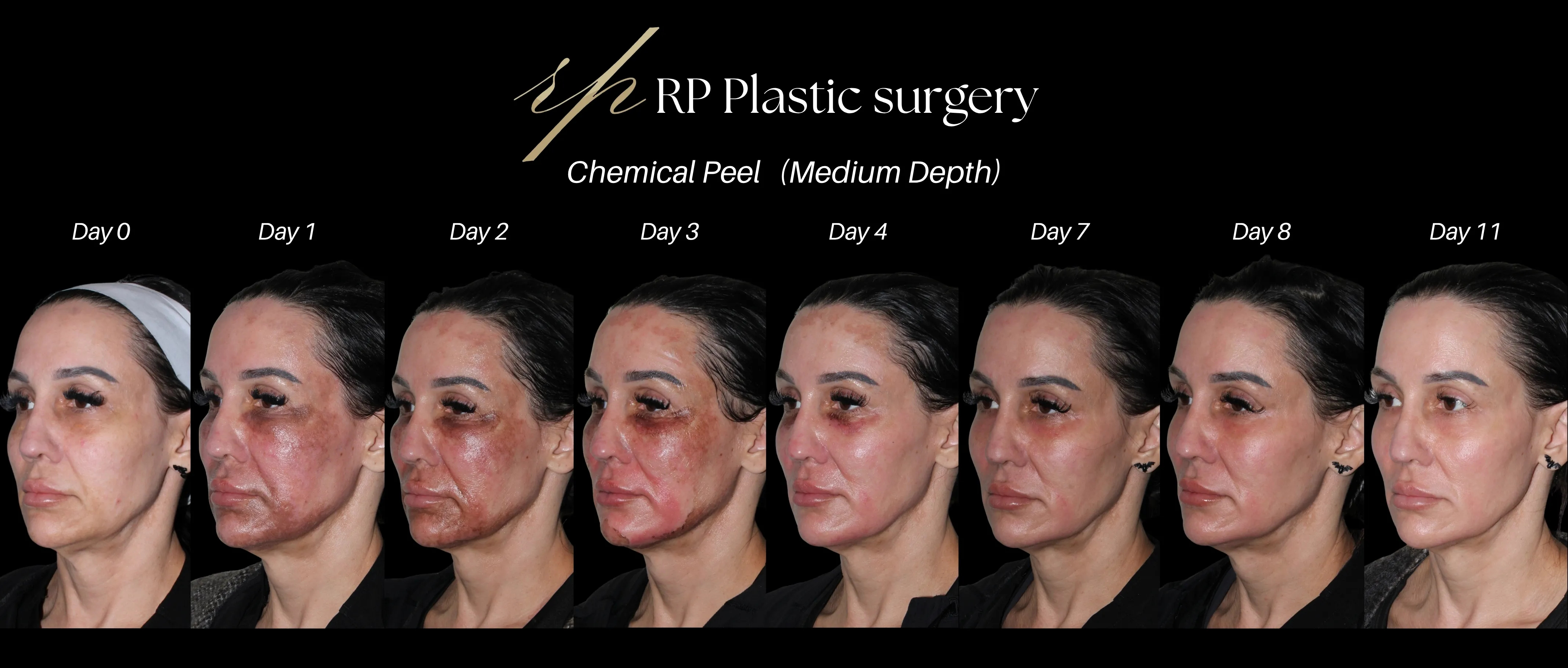 Day 0-11 Chemical Peel result oblique view