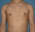 Male Breast Reduction