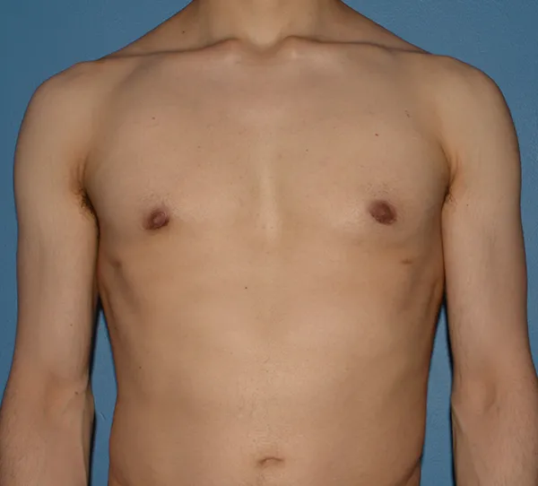 Male Breast Reduction