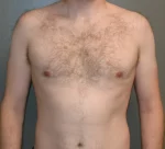 Male Breast Reduction