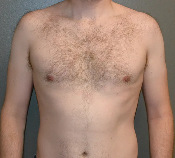 Male Breast Reduction