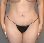 Tummy Tuck