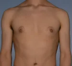 Male Breast Reduction
