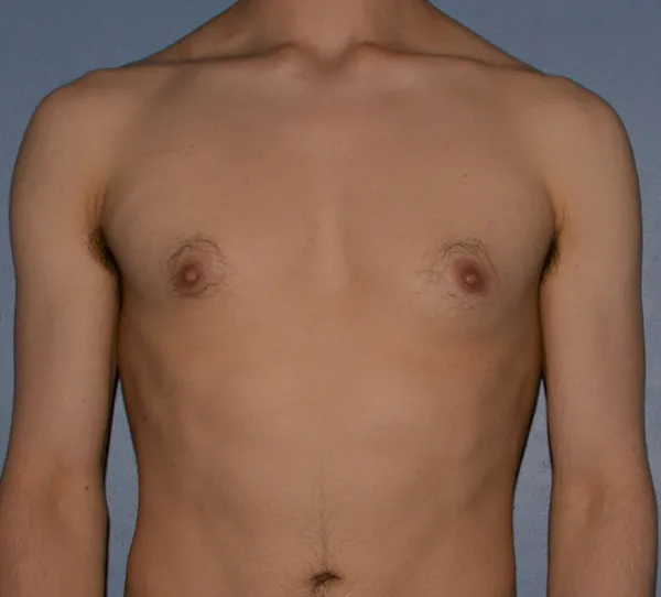 Male Breast Reduction