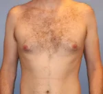 Male Breast Reduction