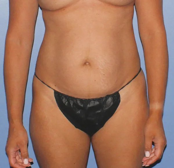 Tummy Tuck