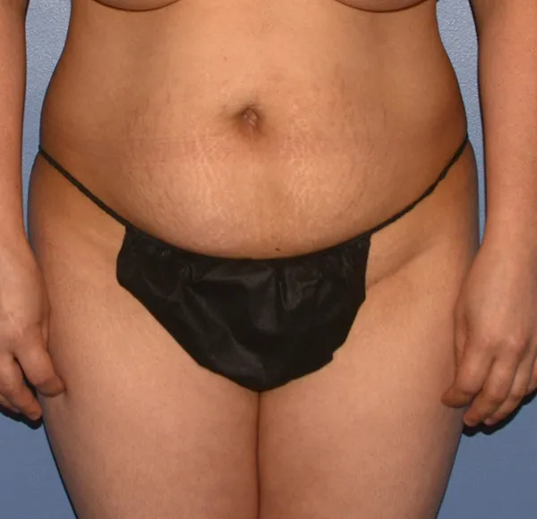 Tummy Tuck