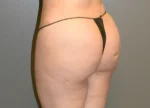 Brazilian Butt Lift