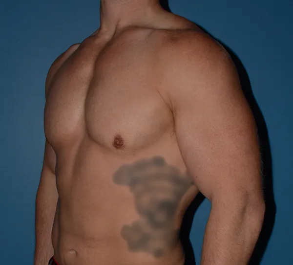 Male Breast Reduction