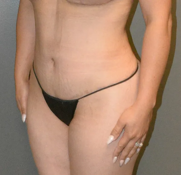 Tummy Tuck