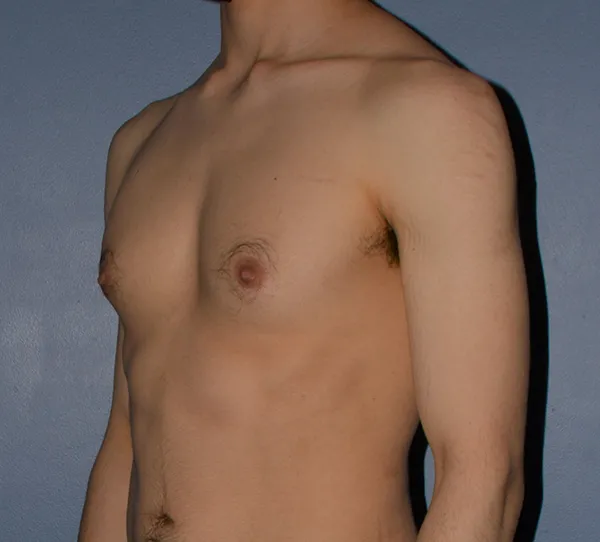 Male Breast Reduction