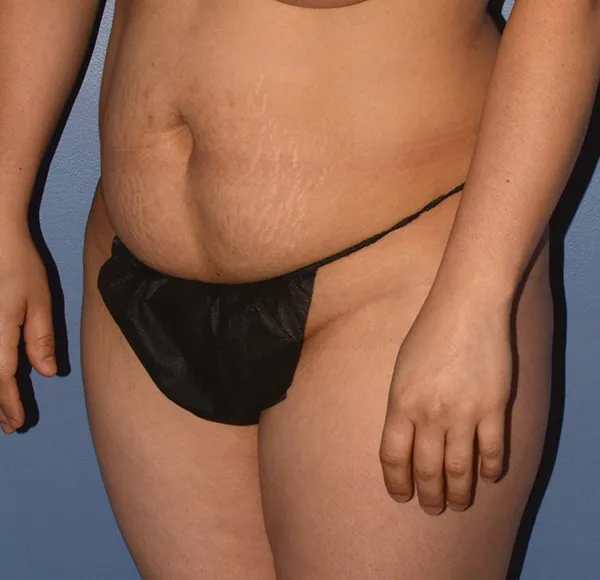 Tummy Tuck