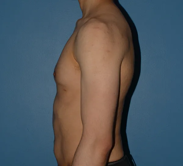 Male Breast Reduction