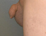 Penile Lengthening