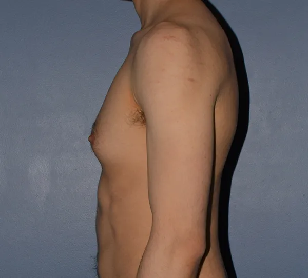 Male Breast Reduction