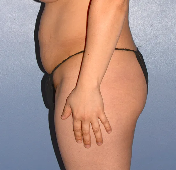Tummy Tuck