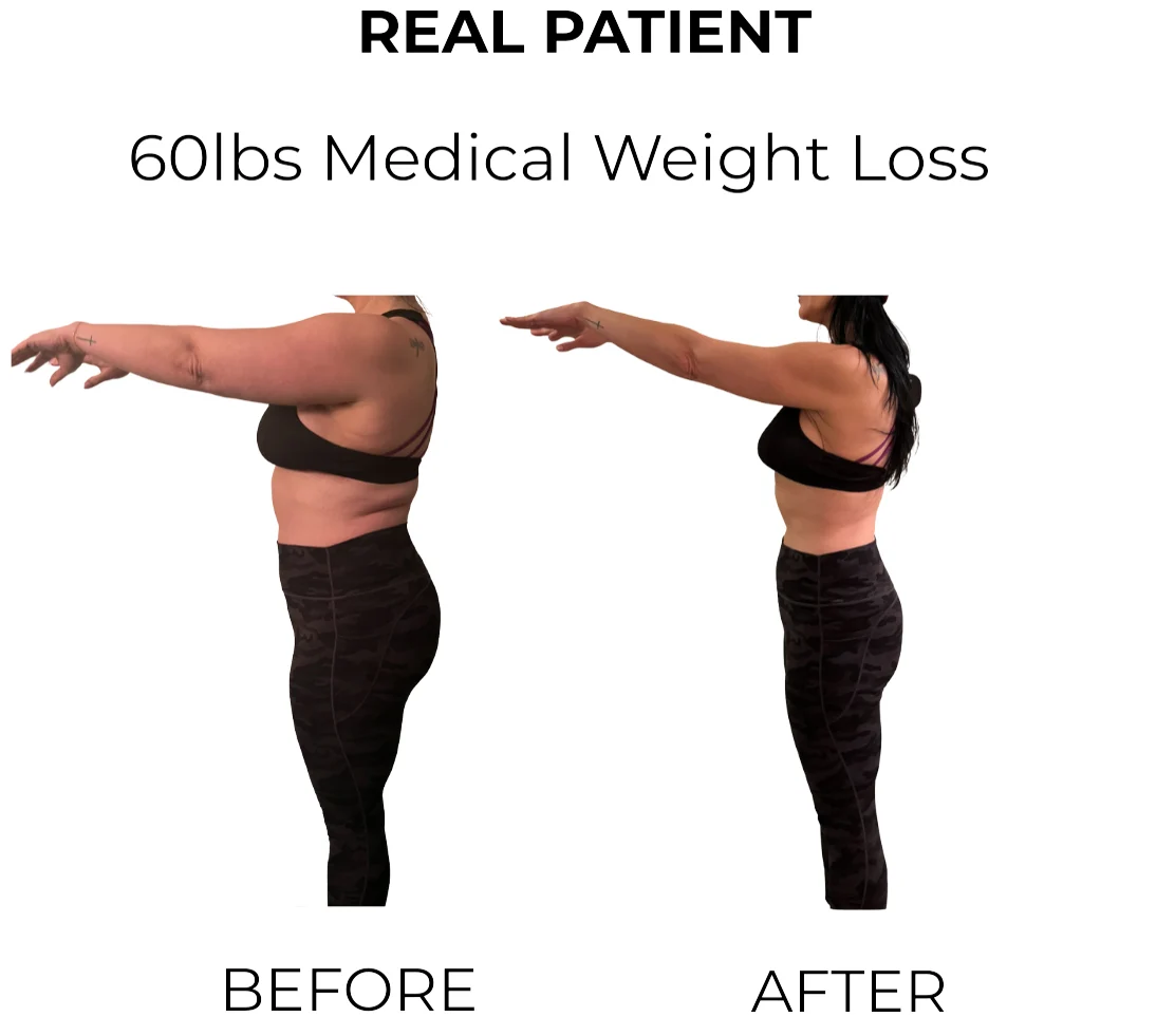 Before and after image of a medical weight loss patient showing a 60lb reduction.