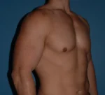 Male Breast Reduction