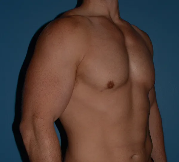 Male Breast Reduction