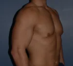 Male Breast Reduction