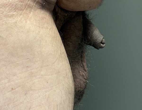Penile Lengthening