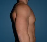 Male Breast Reduction