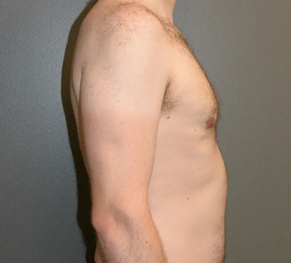 Male Breast Reduction