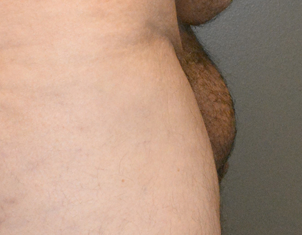Penile Lengthening