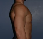 Male Breast Reduction