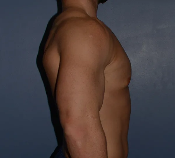 Male Breast Reduction