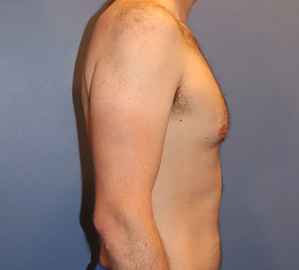 Male Breast Reduction