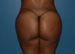 Brazilian Butt Lift