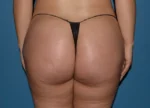 Brazilian Butt Lift