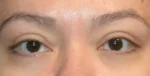 Eyelid Lift