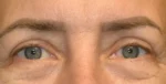 Eyelid Lift