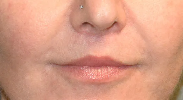Lip Lift