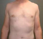 Male Breast Reduction Gynecomastia