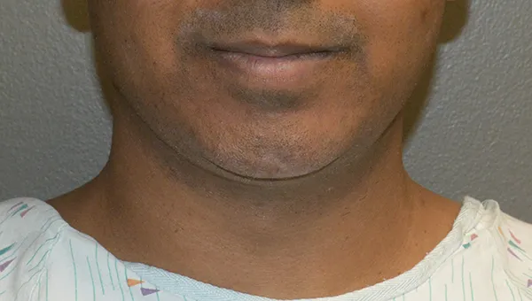 Chin Implant