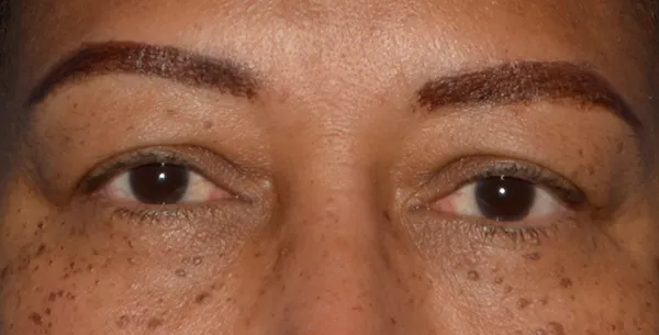 Eyelid Lift
