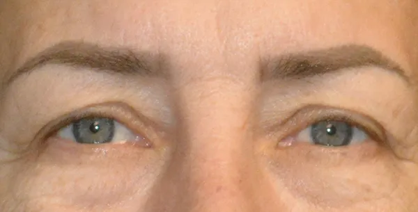 Eyelid Lift