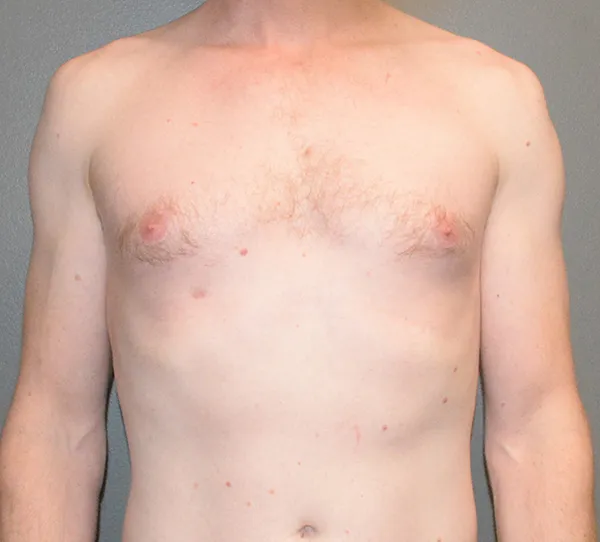 Male Breast Reduction Gynecomastia