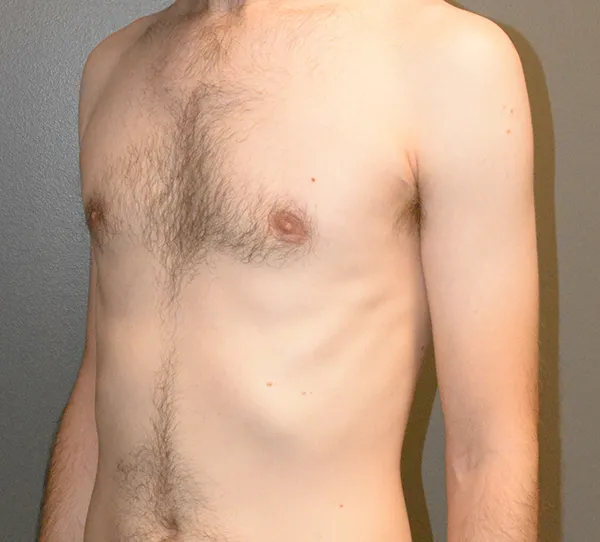 Male Breast Reduction Gynecomastia
