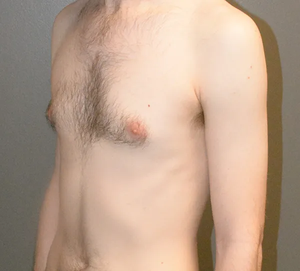 Male Breast Reduction Gynecomastia
