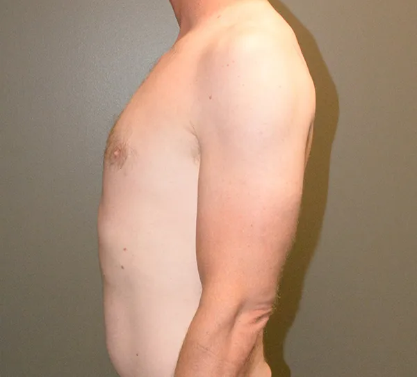 Male Breast Reduction Gynecomastia