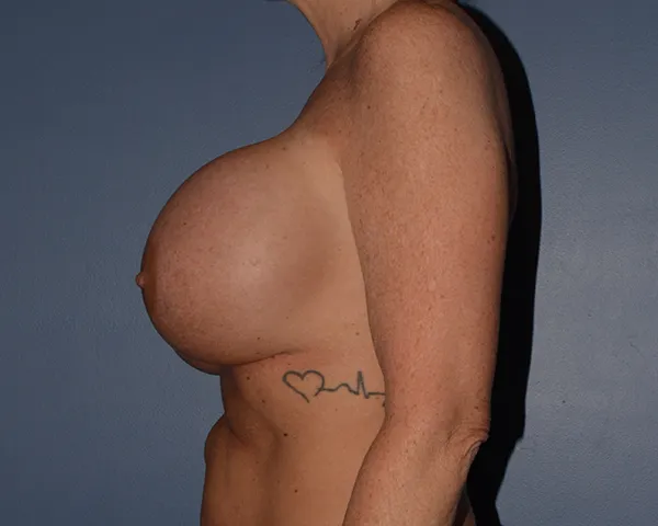 Breast Correction