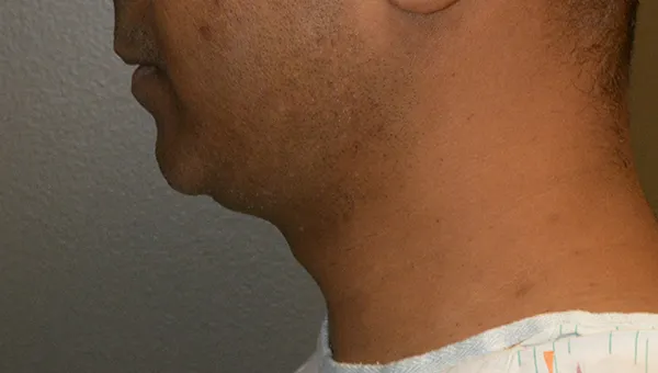 Chin Implant