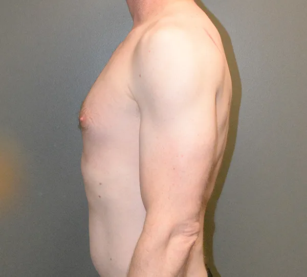 Male Breast Reduction Gynecomastia